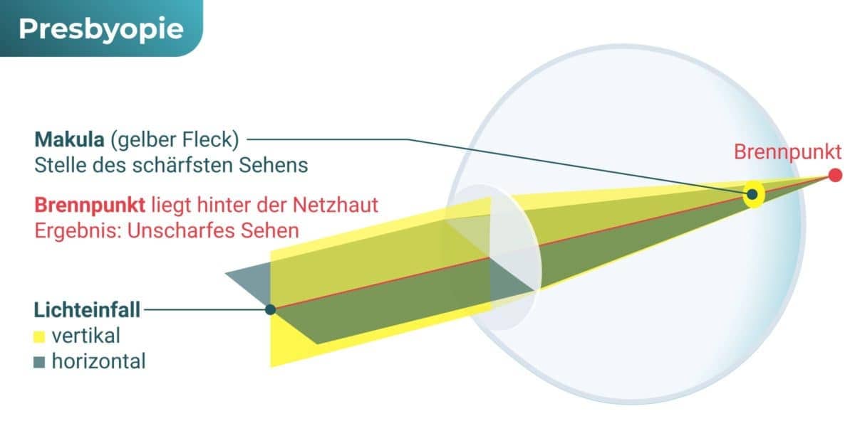 Alterssichtigkeit (Presbyopie) – Fehlsichtiges Auge