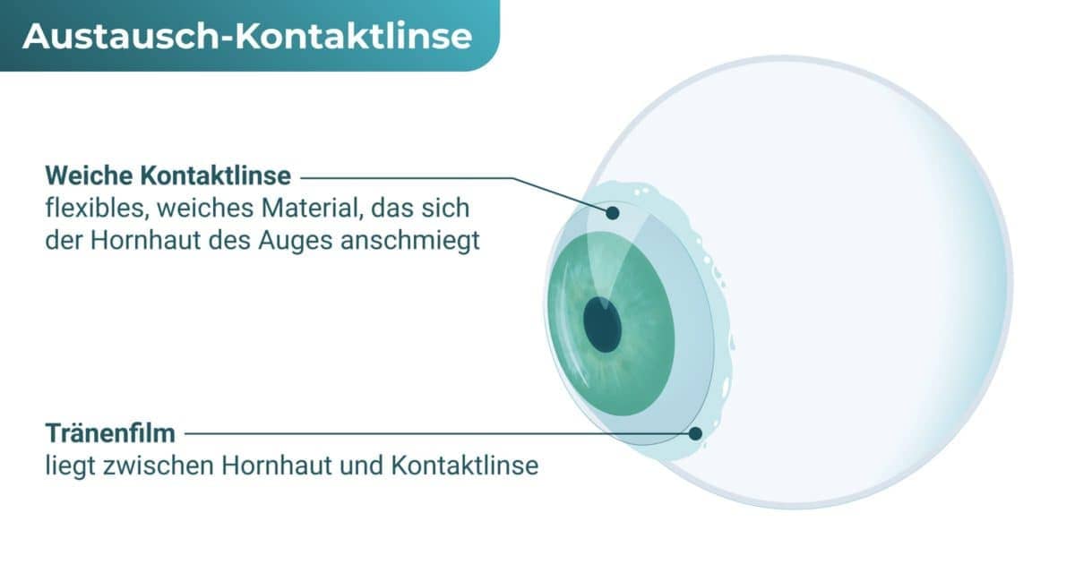 Austausch-Kontaktlinse / Austauschlinse