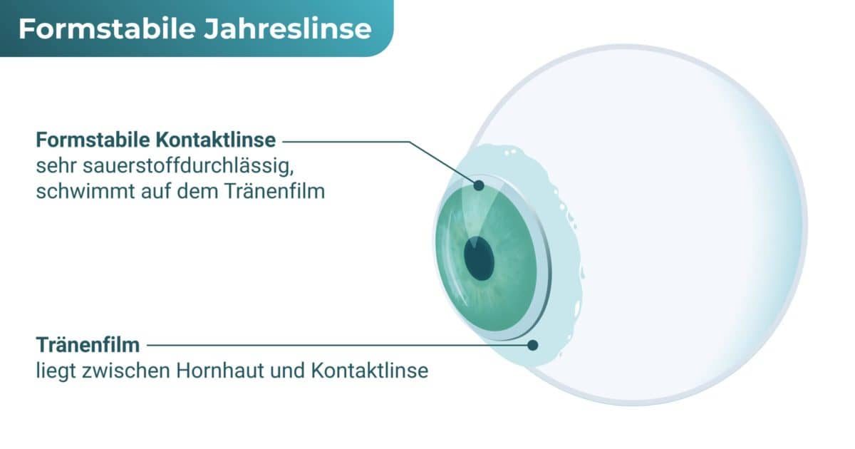 Formstabile Jahreslinse / harte Jahreslinse