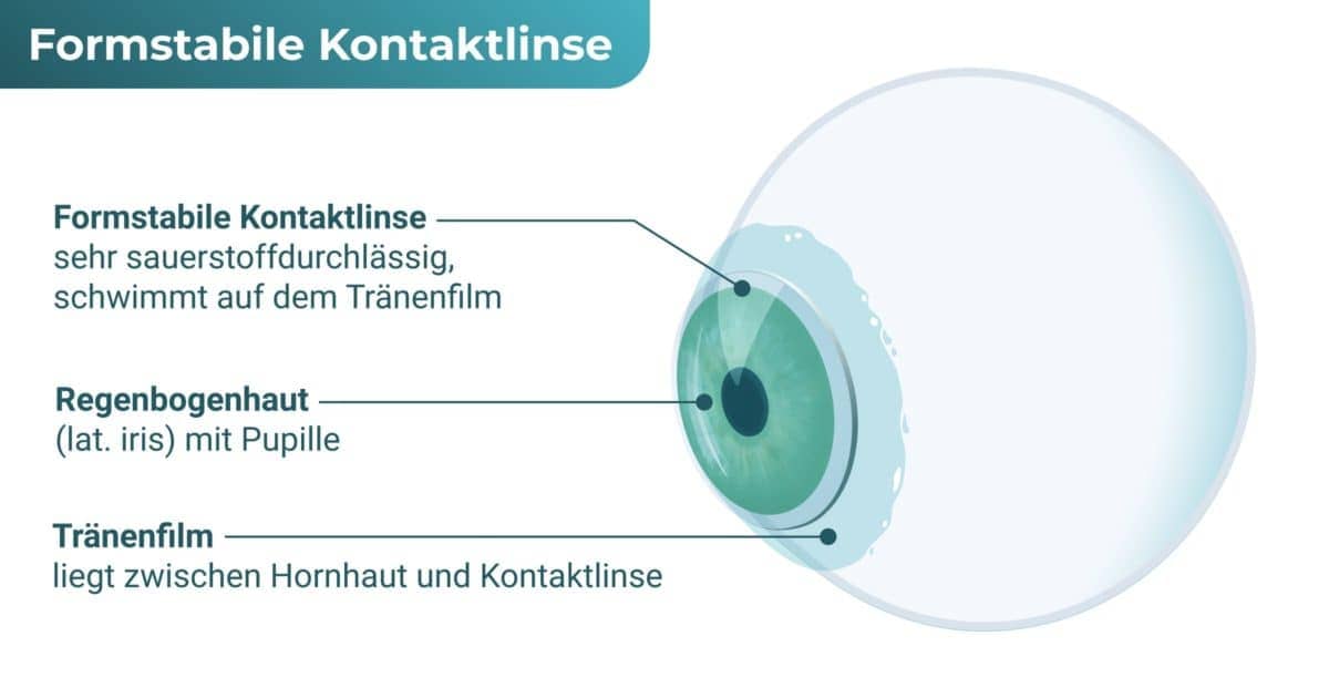 Formstabile Kontaktlinse / Harte Kontaktlinse