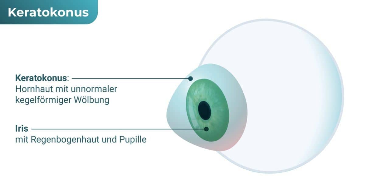 Hornhautkegel (Keratokonus)