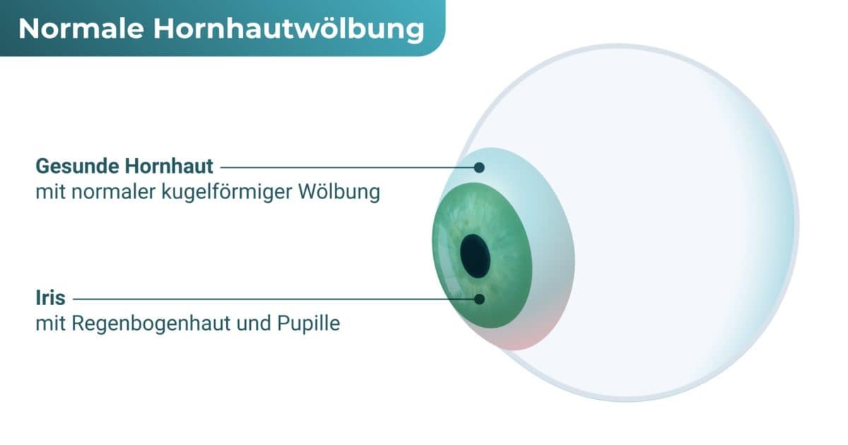 Auge ohne Hornhautkegel (Keratokonus)