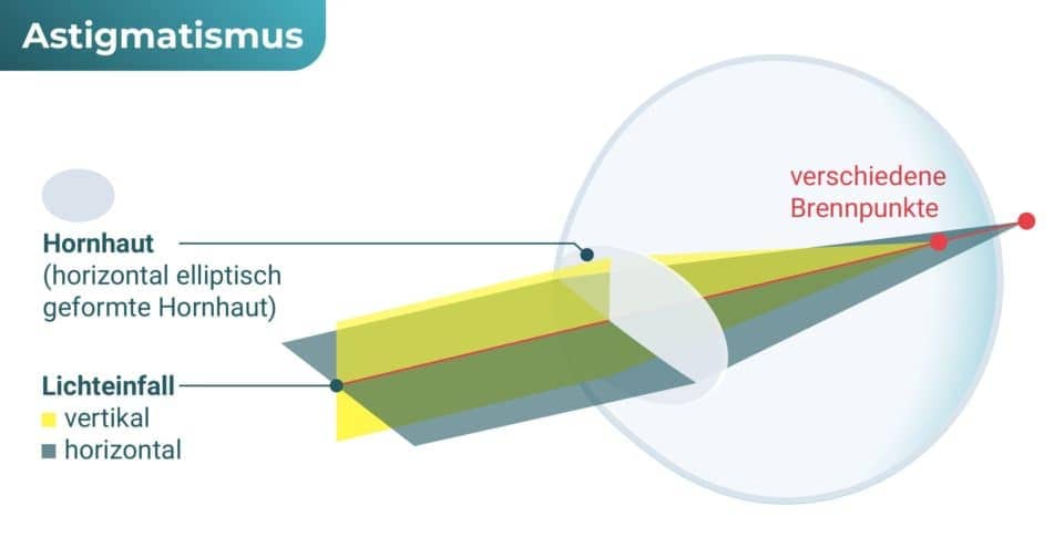 Auge mit Hornhautverkrümmung (Astigmatismus / Stabsichtigkeit)