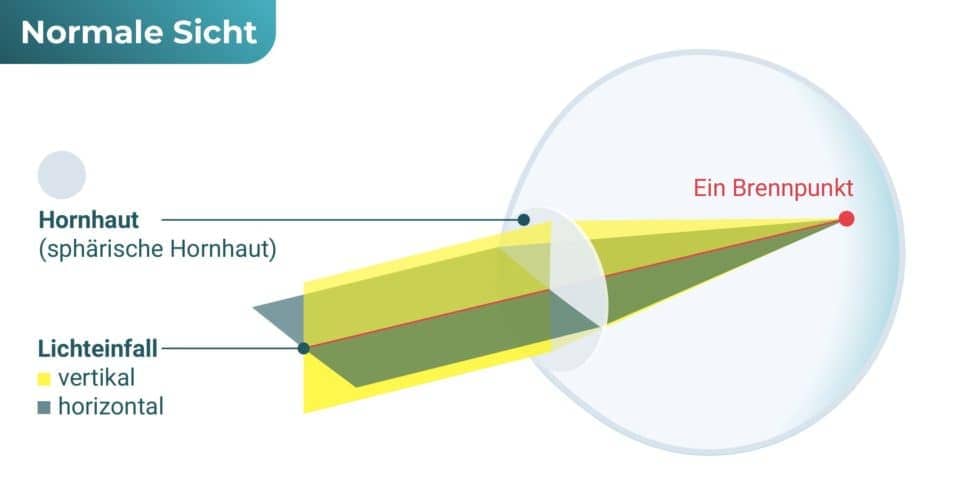 Normalsichtiges Auge – Hornhautverkrümmung (Astigmatismus / Stabsichtigkeit)