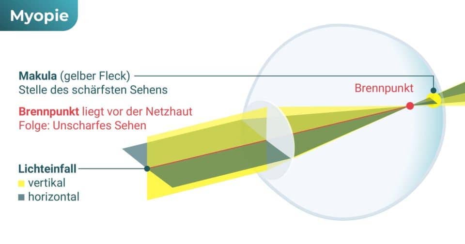 Auge fehlsichtig – Kurzsichtigkeit (Myopie)