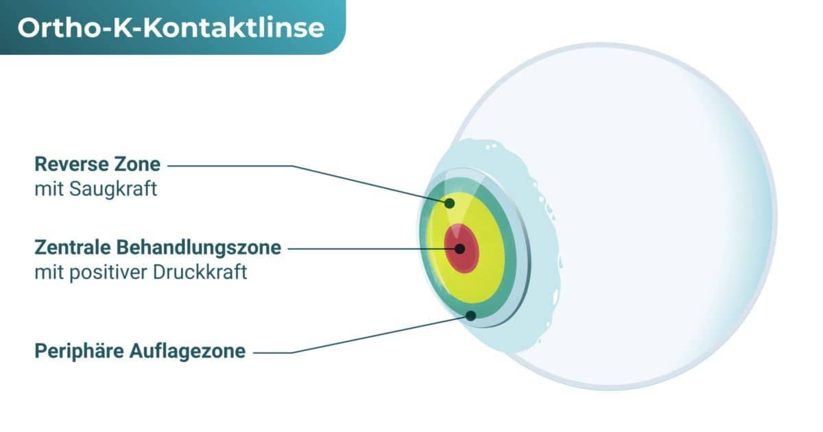 Ortho-K-Kontaktlinsen / Ortho-K-Linsen