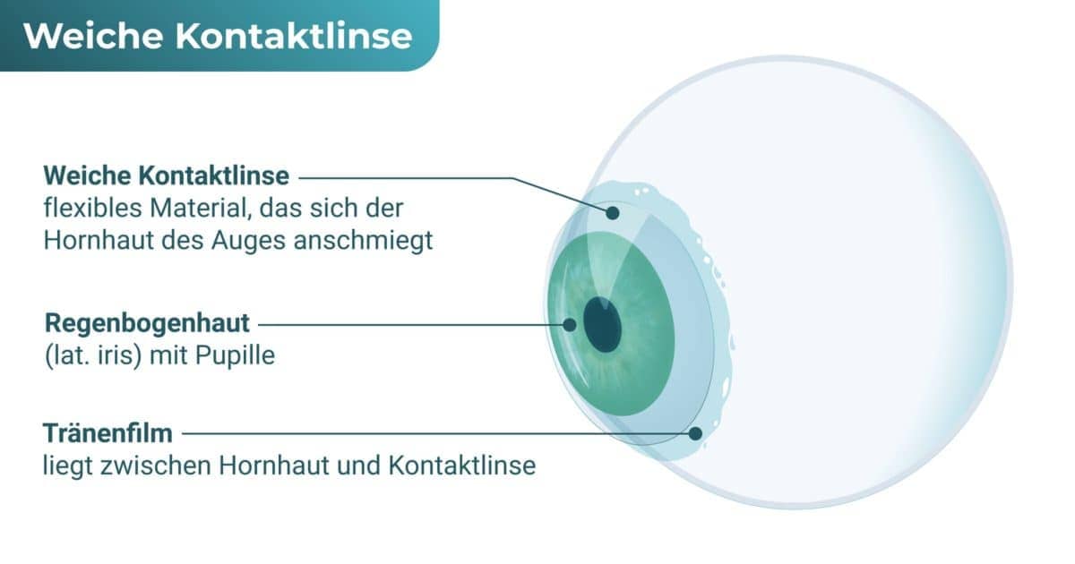 Weiche Kontaktlinse